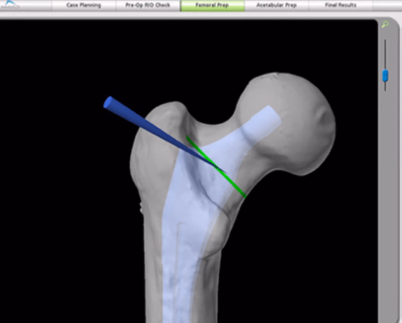 A three-dimensional CT-based Mako surgical planning screen